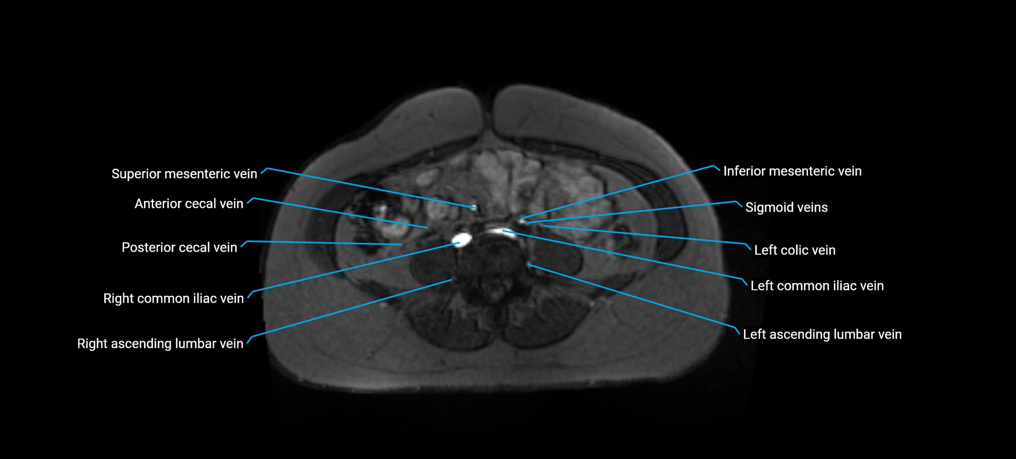 MRV abdomen pelvis & lower limb axial cross sectional anatomy labelled MRI image 118 (1).webp